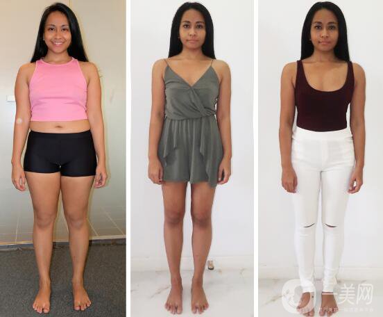 你真的適合吸脂手術(shù)嗎？吸脂適應(yīng)癥介紹