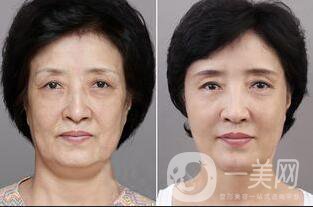 熱瑪吉*果,熱瑪吉后遺癥