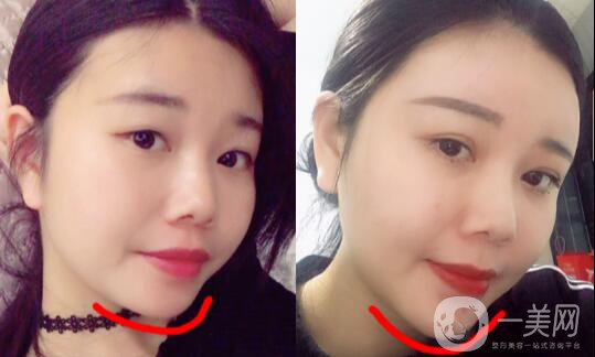 自體脂肪墊下巴恢復(fù)期是怎樣的？如何做好術(shù)后護(hù)理？