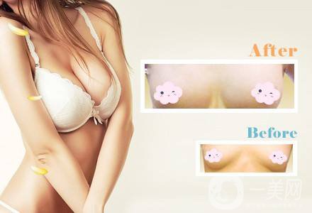 乳房提升怎么樣 隆胸手術(shù)時(shí)間是多久