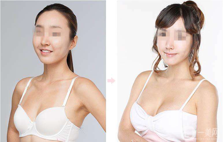 乳房提升怎么樣 隆胸手術(shù)時(shí)間是多久