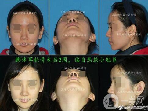 上海九院戴傳昌,上海九院戴傳昌做鼻子,上海九院李青峰