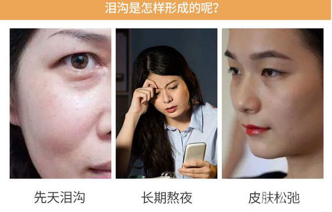 膠原蛋白填淚溝恢復(fù)期是多久呢 術(shù)后護(hù)理要注意什么？