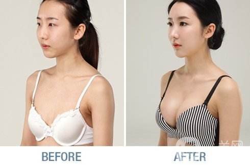 脂肪填充隆胸貴嗎 隆胸手術(shù)費(fèi)用 手術(shù)方式有哪些