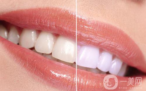 冷光美白牙齒的價格 冷光美白牙齒持久嗎
