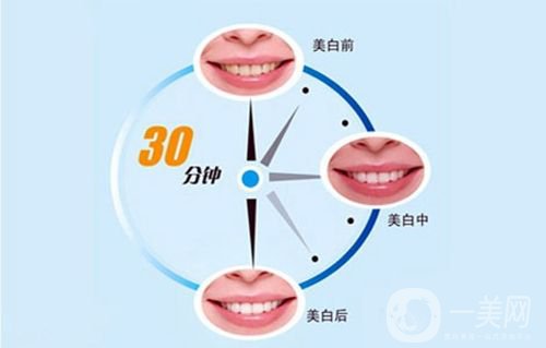 冷光美白牙齒的價格 冷光美白牙齒持久嗎