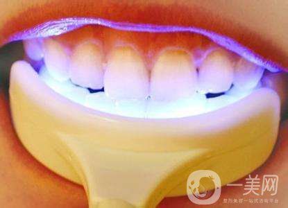 冷光美白牙齒的價格 冷光美白牙齒持久嗎