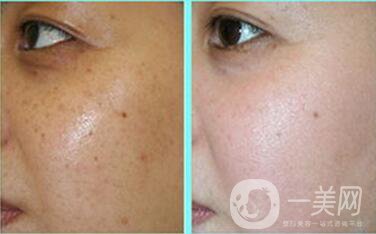 祛斑價(jià)格,北京祛斑多少錢
