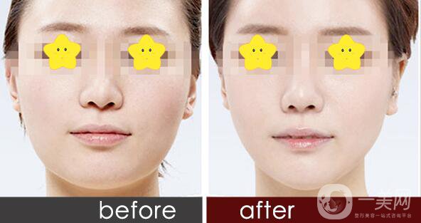 *瘦臉貴嗎,*瘦臉多少錢