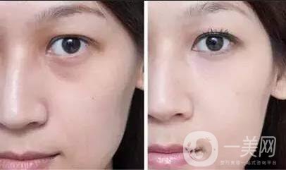 射頻去眼袋貴嗎,射頻去眼袋多少錢