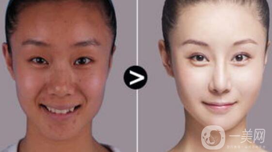 光子嫩膚價格,光子嫩膚*果