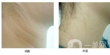 頸部提升的作用是什么 頸部提升*果好不好?