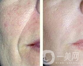 熱瑪吉除皺*果,熱瑪吉除皺風(fēng)險