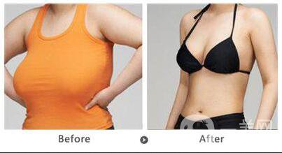 乳房縮小會留疤嗎,乳房縮小多久恢復