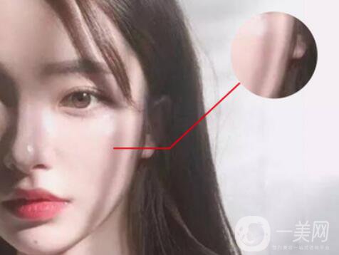 磨顴骨*果怎么樣 有什么風(fēng)險嗎？