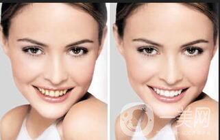 皓齒美白牙齒多少錢,皓齒美白牙齒費用分析