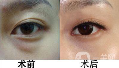 超聲法去眼袋價格,超聲法去眼袋術(shù)后護理