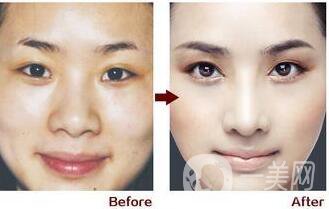 非手術(shù)隆鼻