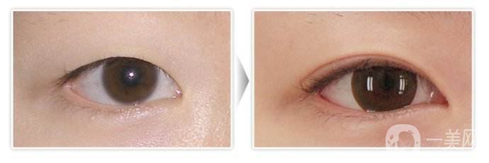 開眼角手術(shù)圖怎么樣 開眼角手術(shù)價(jià)格