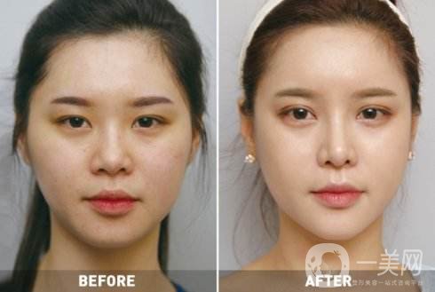 磨骨瘦臉貴嗎 瘦臉的方法有哪些