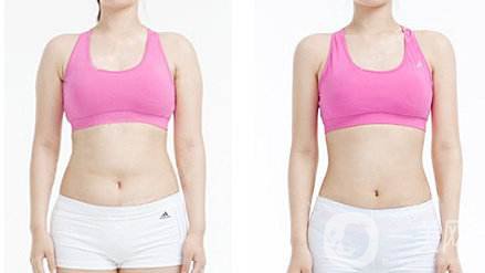 腹部吸脂手術(shù)價格 腹部吸脂手術(shù)危險嗎