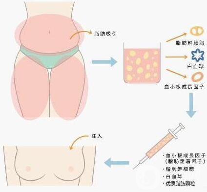 自體脂肪隆胸價格 自體脂肪豐胸后的危害