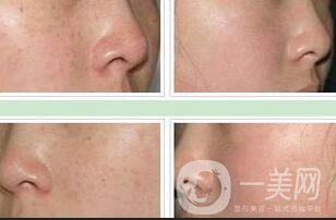 祛斑手術(shù)價(jià)格