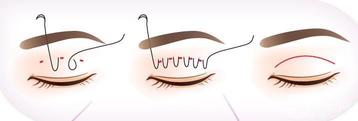 *,BK非切口雙眼皮