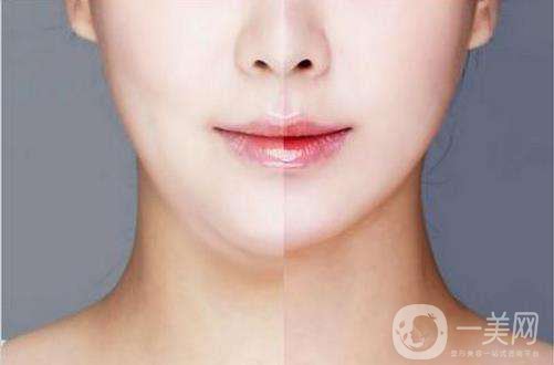 面部吸脂*果圖 面部吸脂注意事項(xiàng)