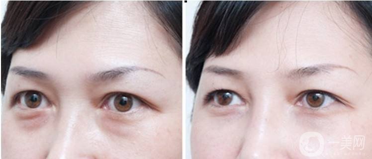 內(nèi)切祛眼袋貴嗎 去眼袋的方法有哪些