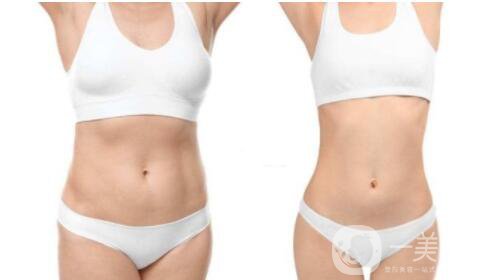 抽脂減肥價格一覽表 抽脂減肥有危害嗎
