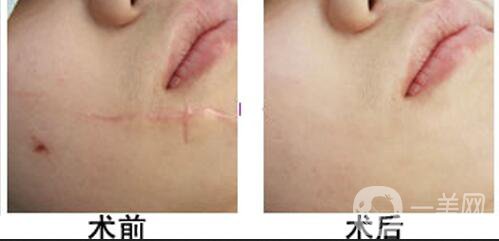 像素激光祛疤價格,像素激光祛疤貴嗎