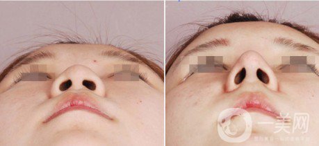 假體隆鼻整型術(shù)怎么樣 什么人不適合做假體隆鼻？