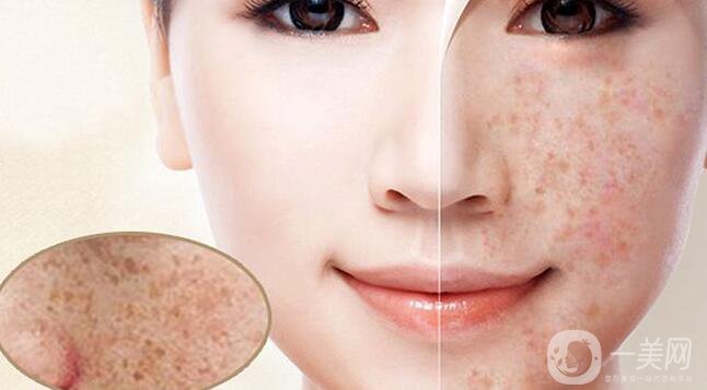 色素沉著如何處理 怎么去除？