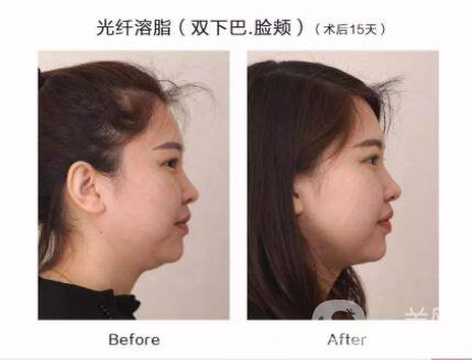 光纖溶脂瘦臉貴嗎 光纖溶脂瘦臉價格是多少