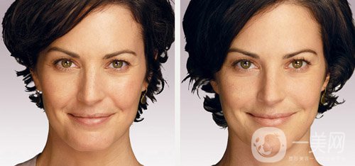 Juvéderm的作用是什么 Juvéderm和其他材料的區(qū)別