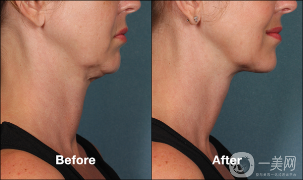 Juvéderm的作用是什么 Juvéderm和其他材料的區(qū)別