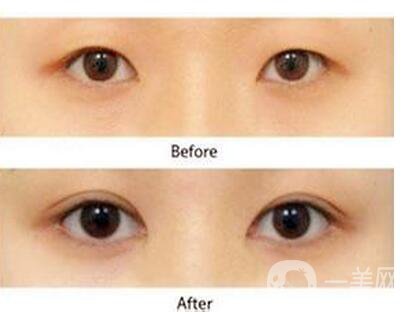三點(diǎn)定位割雙眼皮圖片,三點(diǎn)定位割雙眼皮缺陷