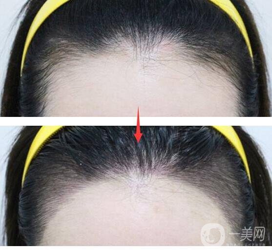 種植發(fā)際線可靠嗎,種植發(fā)際線*果如何