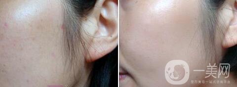 點痣多少錢一顆 點痣后要注意什么