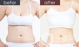 小腹肌成形術(shù)風(fēng)險(xiǎn)有多大 小腹肌成形術(shù)的恢復(fù)時(shí)間