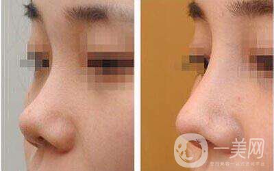 鼻翼怎么變小竅門 鼻翼變小的方法