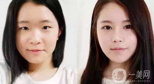 什么眼皮不能割雙眼皮手術(shù) 割雙眼皮注意事項(xiàng)