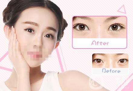 什么眼皮不能割雙眼皮手術(shù) 割雙眼皮注意事項(xiàng)