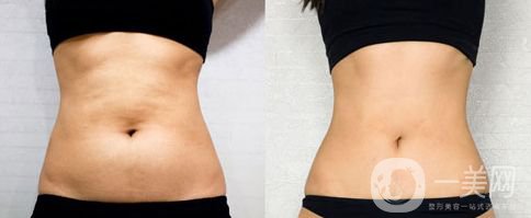 沃斯堡腹壁成形術(shù)風(fēng)險(xiǎn)大嗎 多久恢復(fù)呢