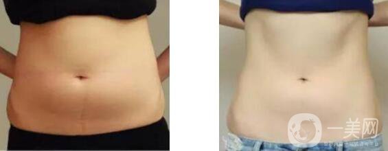 沃斯堡腹壁成形術(shù)風(fēng)險(xiǎn)大嗎 多久恢復(fù)呢