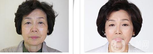 整容手術要多久時間 整容手術風險有多大