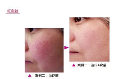 有紅血絲怎么辦 紅血絲如何修復(fù)