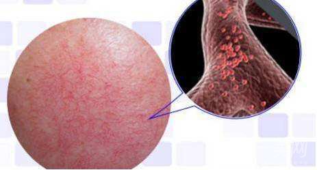 有紅血絲怎么辦 紅血絲如何修復(fù)