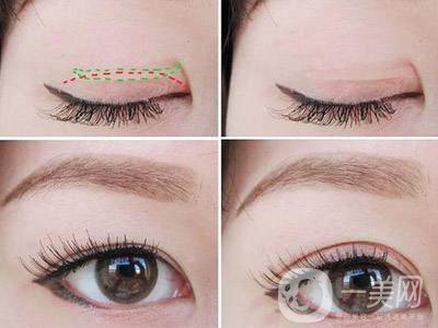 雙眼皮開眼角手術時間 雙眼皮開眼角痛嗎